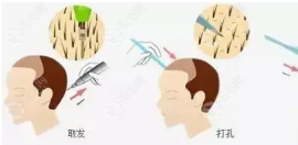 昆明植发一个毛囊多少钱,昆明剃发/不剃发价格为10、12、50起