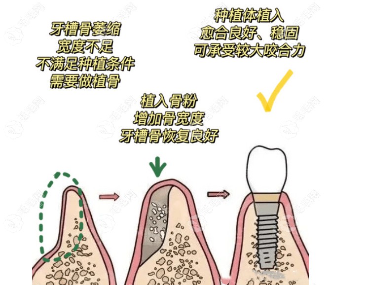 种植牙植骨和不植骨的区别