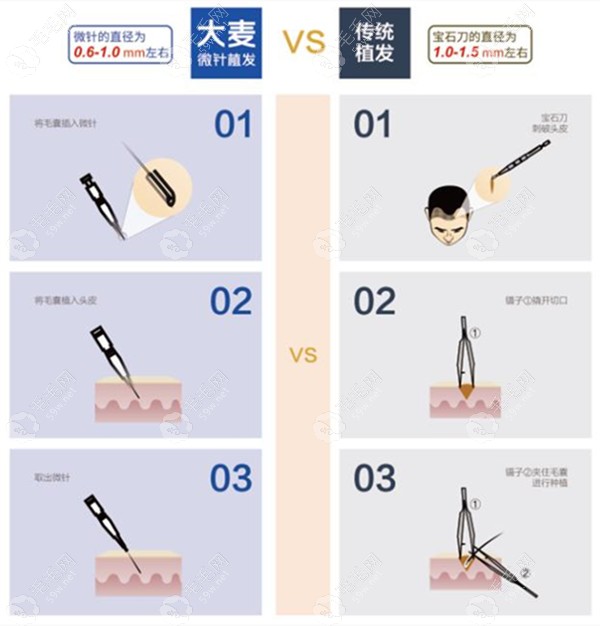 青岛大麦植发操作示意对比图