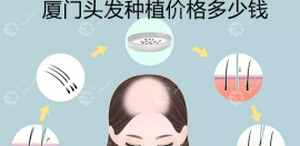 厦门植发价格多少钱左右?植发际线/头顶加密植发价格全览
