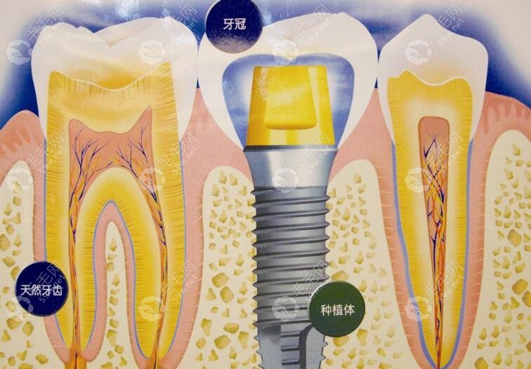 种植牙动画图www.59w.net