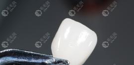 牙齒貼面做了后悔死了:我做了牙貼面感覺像齙牙有點抑郁