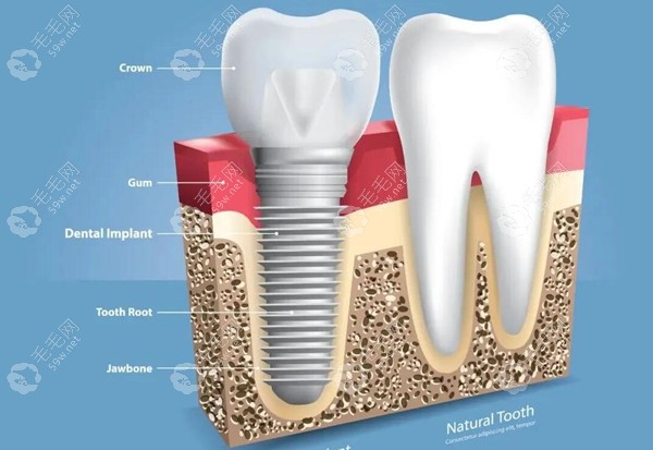 种植牙结构示意图