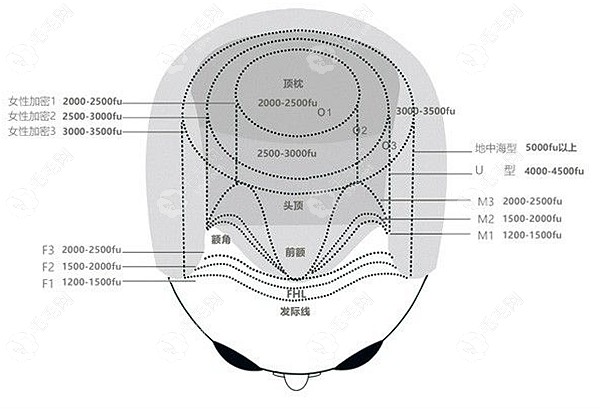 毛发移植术后养护服务 毛毛网