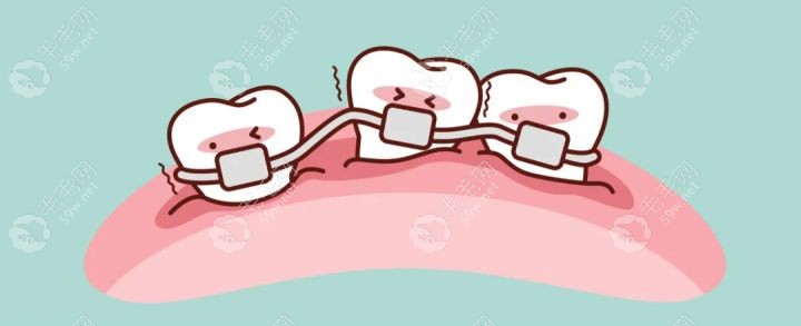 戴金属牙套矫正多少钱59w.net
