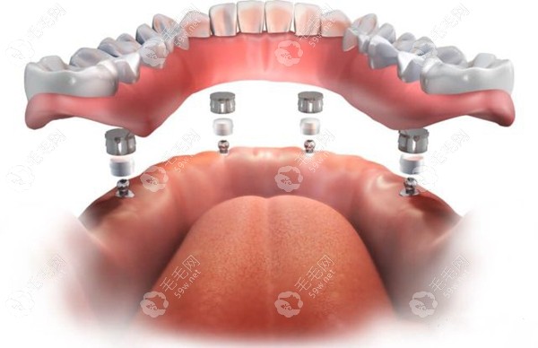 不同技术的全口种植牙价格