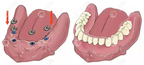 全口半固定种植牙费用