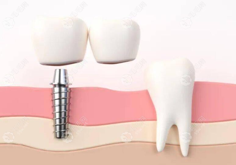 后牙缺失两颗只种一颗