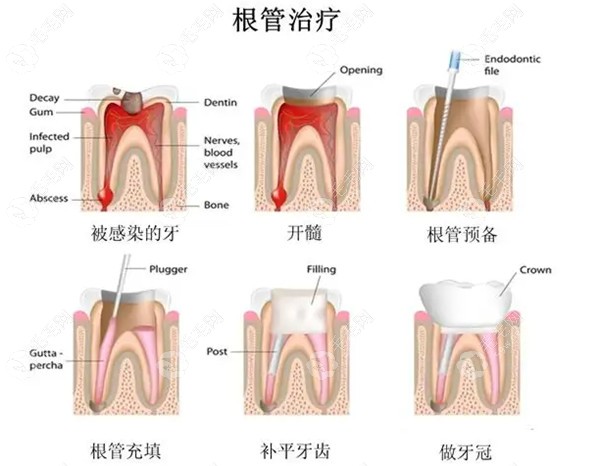 深圳口腔医院根管治疗价格