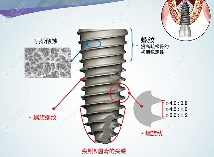 ts植体外观