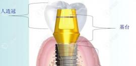 陕西种植牙集采新消息-单颗植体便宜约50%,医疗费至高4300元..