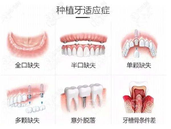 2023牙科收费价目表有调整,今年种植牙/牙齿矫正价格是这样