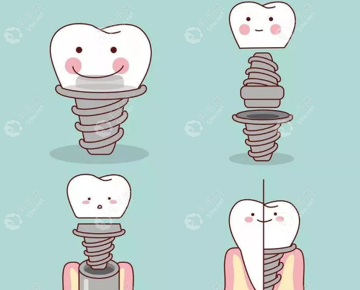 巩新科医生做种植牙优势 59w.net