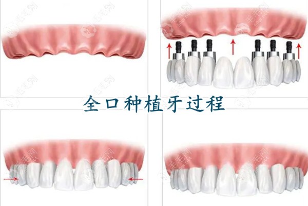 重庆团圆口腔医院种植牙价格