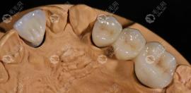 二氧化锆牙分几个档次?600/1000/1500价格的全瓷牙材质就不同吗