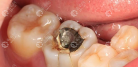 大牙爛了只剩一點空殼了怎么辦?可補牙修復(fù)或拔掉做種植牙