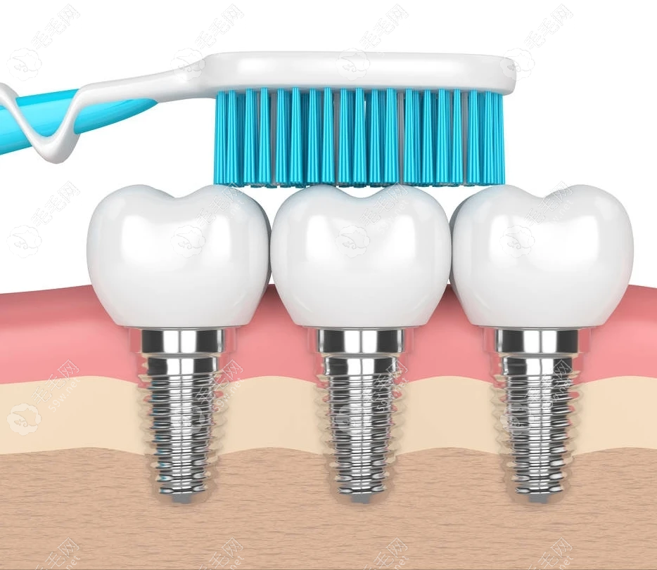 种植牙结构示意图www.59w.net