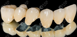 烤瓷牙和全瓷牙哪個(gè)比較好?從區(qū)別和優(yōu)缺點(diǎn)看全瓷牙更好些