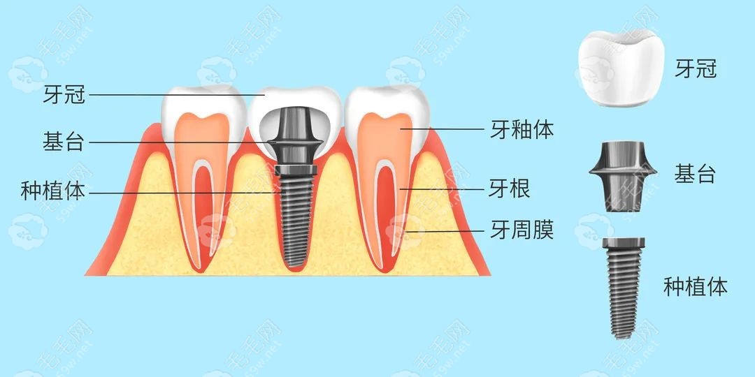 人工种植牙结构解剖图