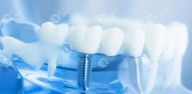 合肥口腔医院种植牙多少钱一颗?集采后2025年种牙价格2980元+