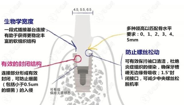 仕诺康植体