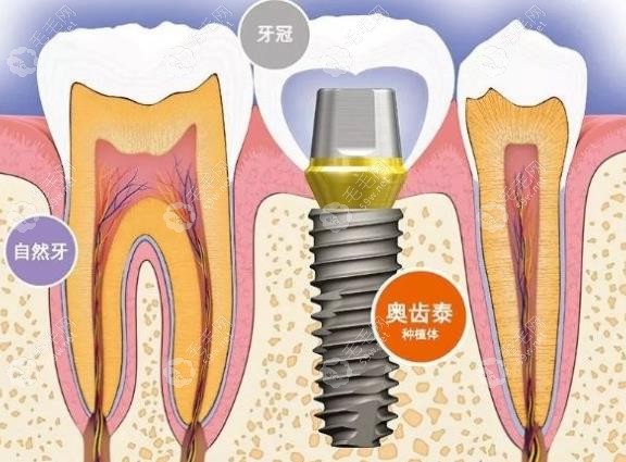 韩国奥齿泰植体www.59w.net