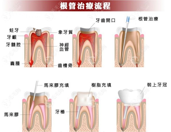 根管治疗流程步骤