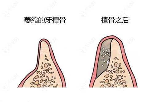 为啥说千万不能做牙槽骨手术