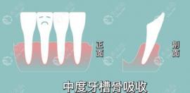 网传千万不能做牙槽骨手术:因为牙槽骨手术危险...