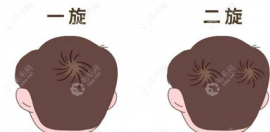 头顶旋涡再造植发多少钱?发旋秃用植发覆盖的价格在15000+