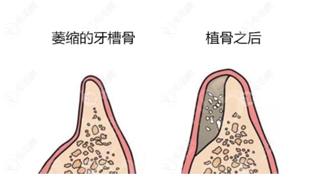 种牙牙槽骨的标准条件