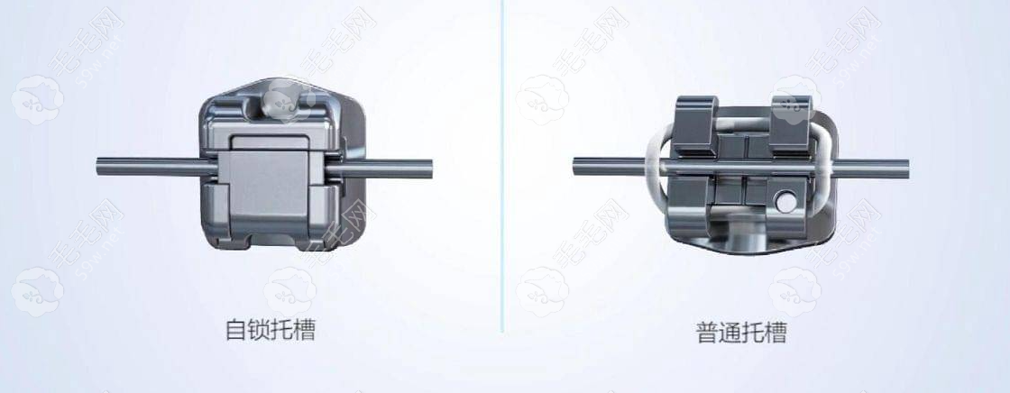 自锁托槽和传统托槽牙套