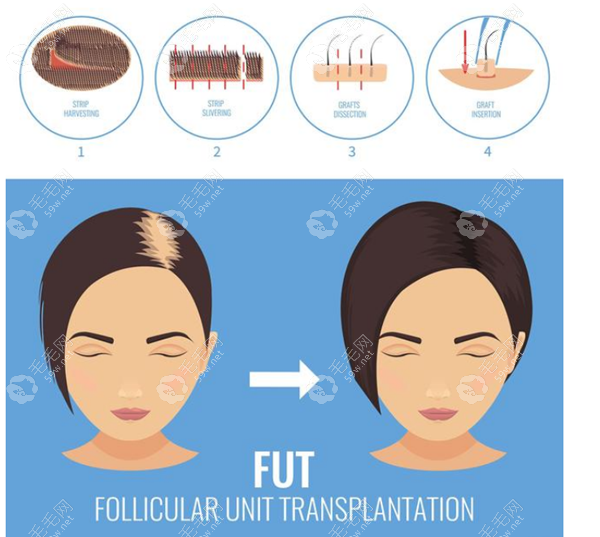 韩国FUT切开植发技术