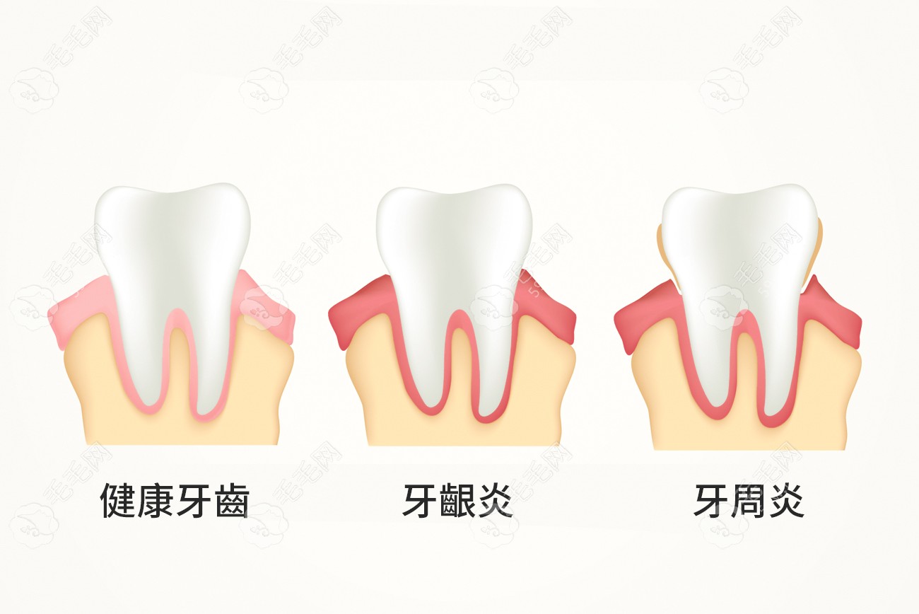 全口牙松动怎么处理