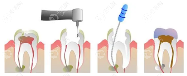 牙齿根管治疗的步骤