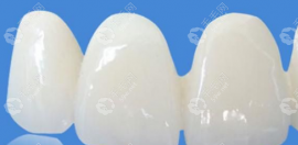 進口威蘭德全瓷牙1200/1600元是真的嗎?這個價格不貴但能用嗎?