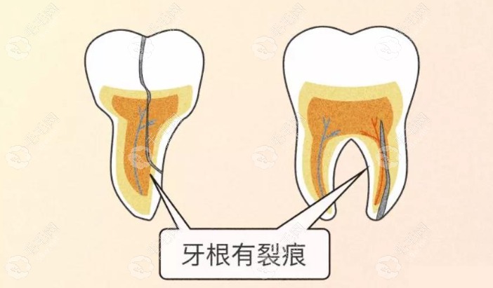 牙隐裂的主要症状是什么59w.net