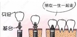 种牙进口的和国产的差距大吗?区别主要在材料/工艺/价格等