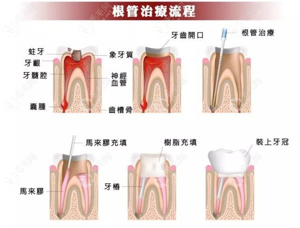 蛀牙到什么程度要做根管治疗59w.net