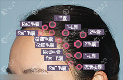 阜阳曙光植发际线技术细节