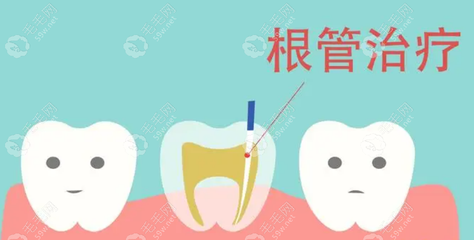 前牙根管治疗 毛毛网