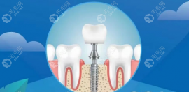 2023年种植牙新政策:未纳入医保报销,但多地下调种植牙价格