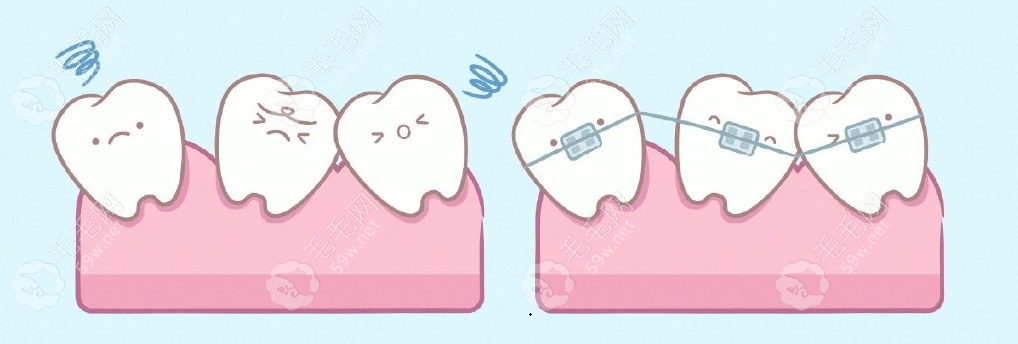 杭州成人矫正牙齿多少钱59w.net