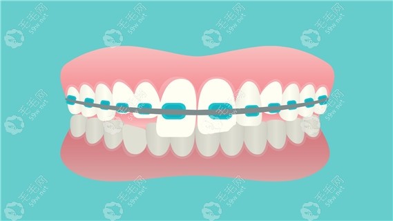 正畸选金属牙套好还是陶瓷牙套好?金属和陶瓷托槽各有利弊