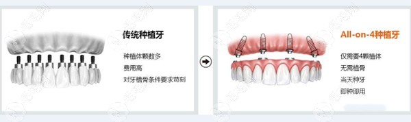 老年人普通满口种植牙多少钱