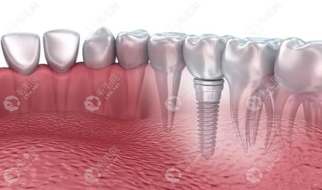 种植牙结构示意图www.59w.net