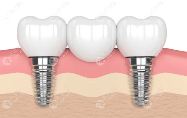 连着4颗牙齿缺失做种植牙价格一般1.5-5万元左右
