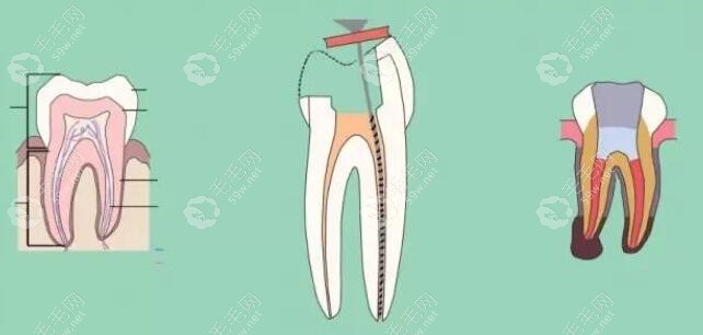 根管治疗各操作步骤