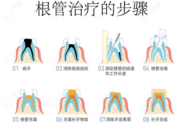 根管治疗的步骤59w.net