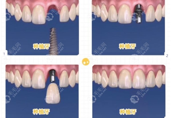 牙齿种植步骤图解